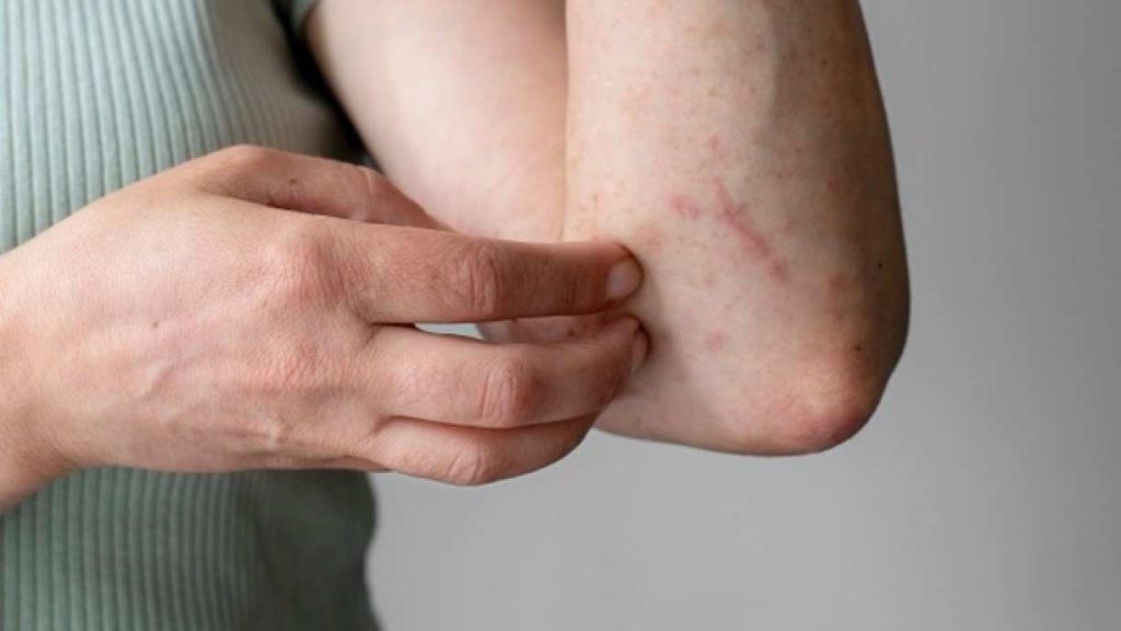 Casos de lesões cutâneas em PE: Estado  contabiliza mais de 233 notificações Casos de lesões cutâneas em PE