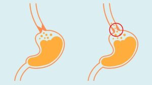 Refluxo gastroesofágico: operar é a solução?