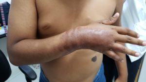Hanseníase: alerta geral segue no Estado do Pernambuco