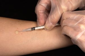 Tuberculose em 2022: Brasil registra 78 mil novos casos